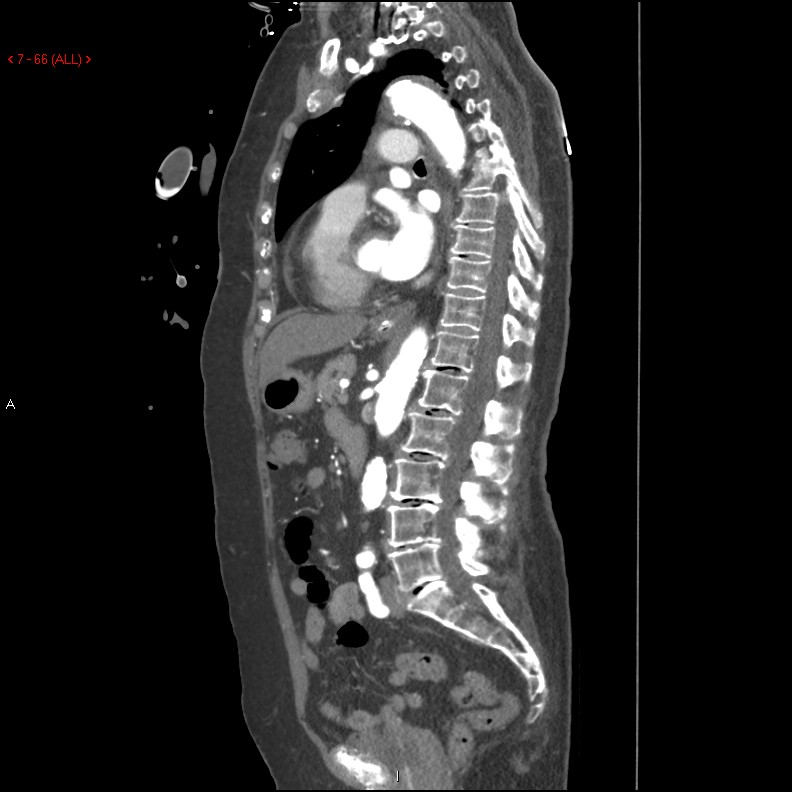 Aortic intramural hematoma (Radiopaedia 27746-28001 C 35).jpg