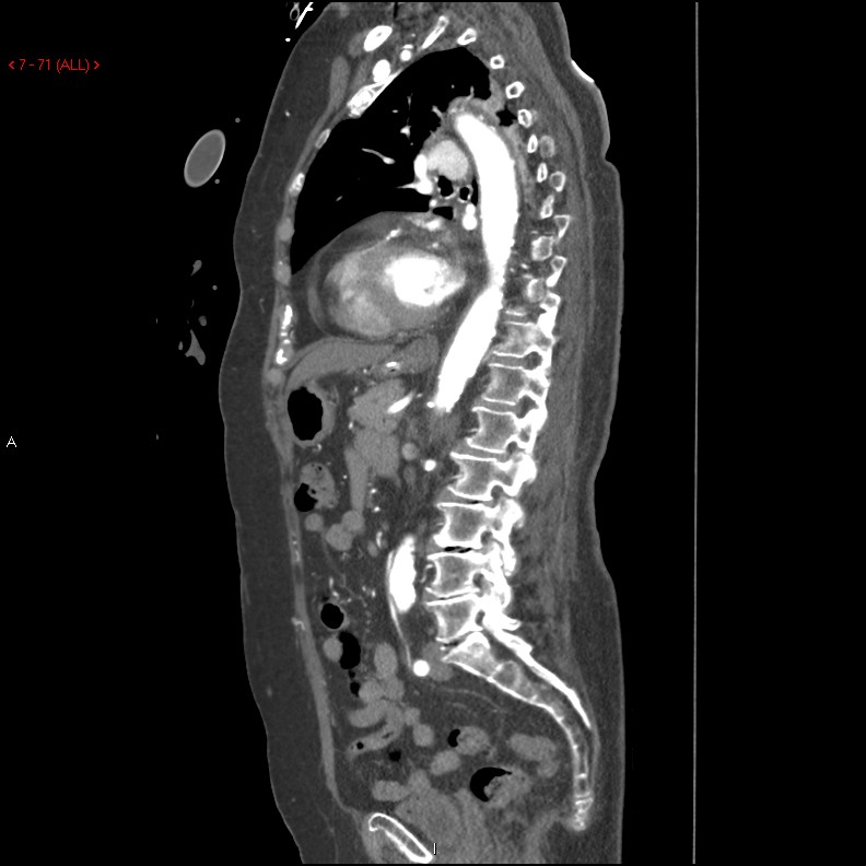 Aortic intramural hematoma (Radiopaedia 27746-28001 C 40).jpg