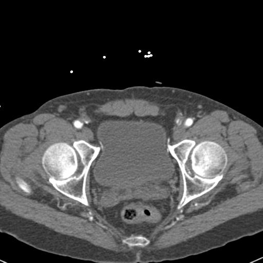 File:Aortic intramural hematoma (Radiopaedia 31139-31838 B 162).jpg
