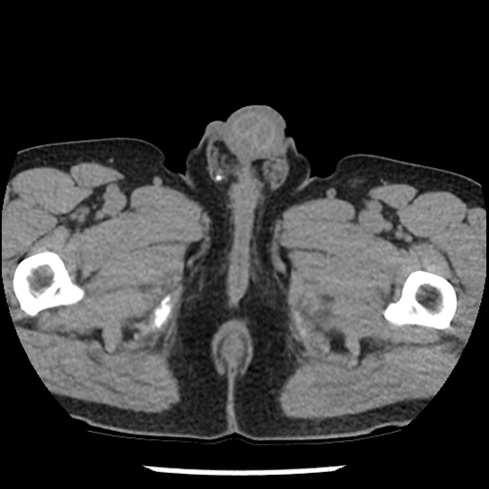 Aortic intramural hematoma (type B) (Radiopaedia 79323-92387 Axial non-contrast 126).jpg