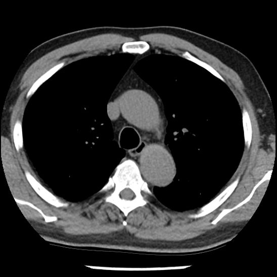 Aortic intramural hematoma (type B) (Radiopaedia 79323-92387 Axial non-contrast 16).jpg