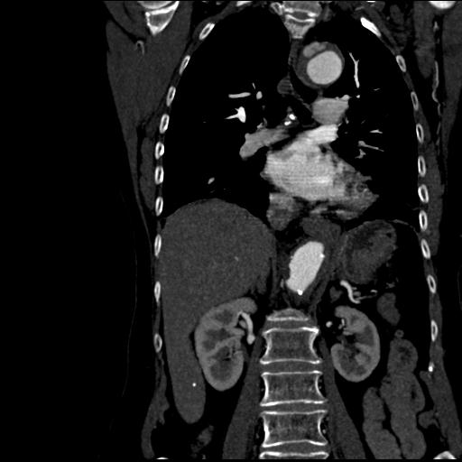 Aortic intramural hematoma from penetrating atherosclerotic ulcer (Radiopaedia 31137-31836 C 37).jpg