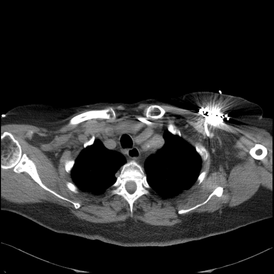 Aortic intramural hematoma with dissection and intramural blood pool (Radiopaedia 77373-89491 Axial non-contrast 20).jpg