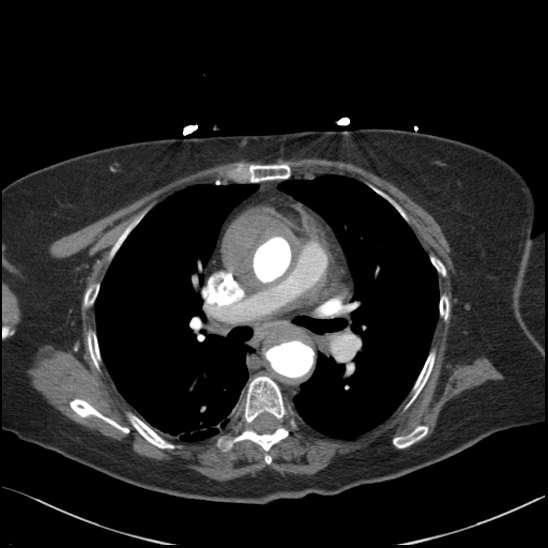 Aortic intramural hematoma with dissection and intramural blood pool (Radiopaedia 77373-89491 B 55).jpg
