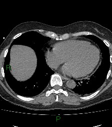 Aortic valve endocarditis (Radiopaedia 87209-103485 Axial non-contrast 70).jpg