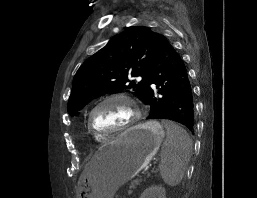 Aortoesophageal fistula with endovascular repair (Radiopaedia 73781-84592 Sagittal C+ CTPA 143).jpg