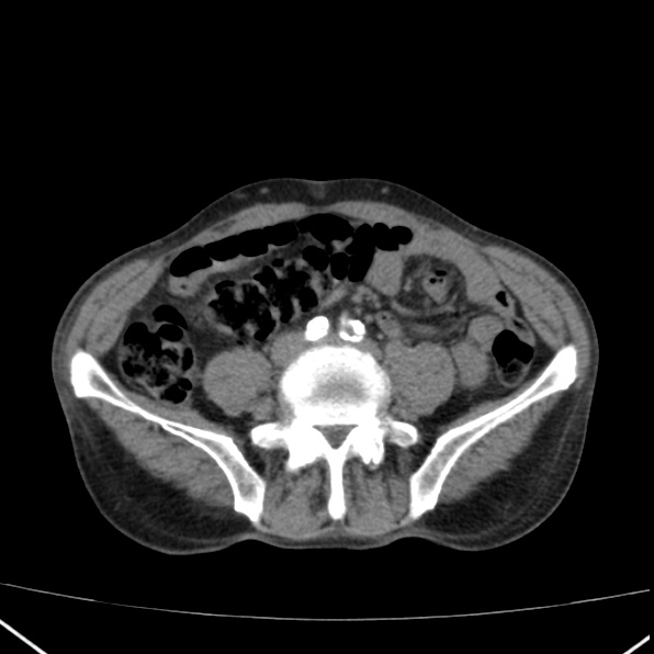 Aortoiliac occlusive disease (Radiopaedia 32134-33076 Axial non-contrast 32).jpg