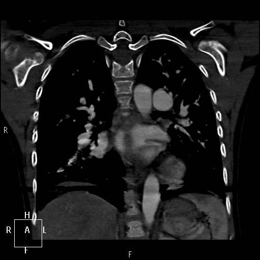File:Aortopulmonary septal defect (Radiopaedia 41990-45013 Coronal C+ CTPA 44).jpg