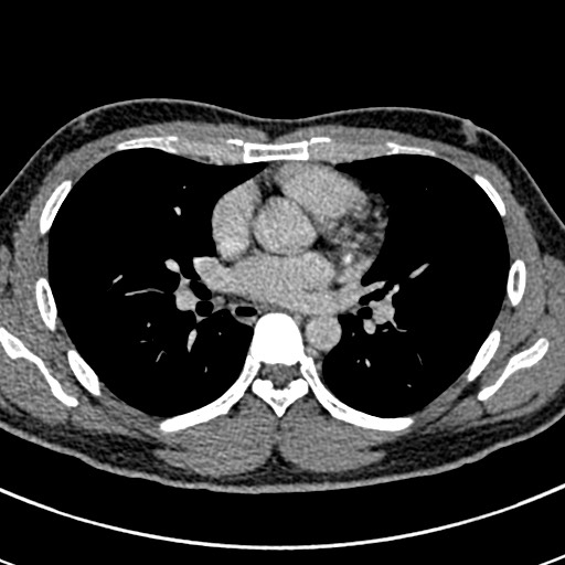 Apical lung mass mimic - neurogenic tumor (Radiopaedia 59918-67521 A 42).jpg