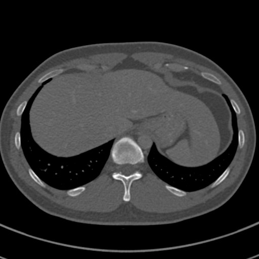 Apical lung mass mimic - neurogenic tumor (Radiopaedia 59918-67521 Axial bone window 72).jpg