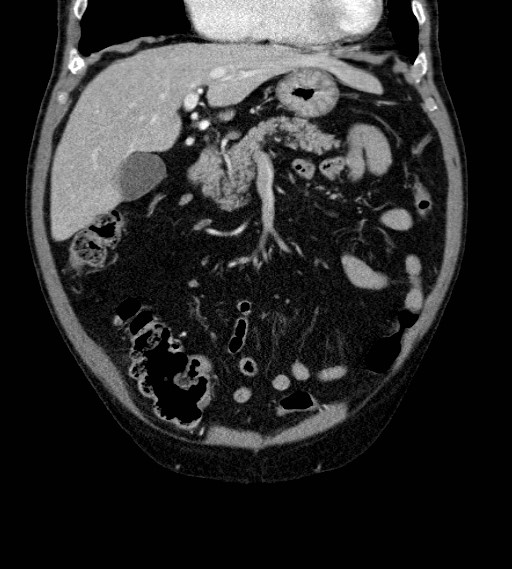 Appendiceal adenocarcinoma complicated by retroperitoneal abscess (Radiopaedia 58007-65039 A 29).jpg
