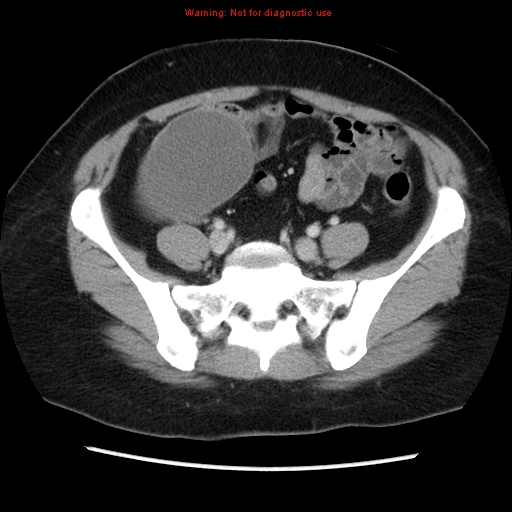 Appendiceal mucinous cystadenoma (Radiopaedia 8263-9111 Axial liver window 59).jpg