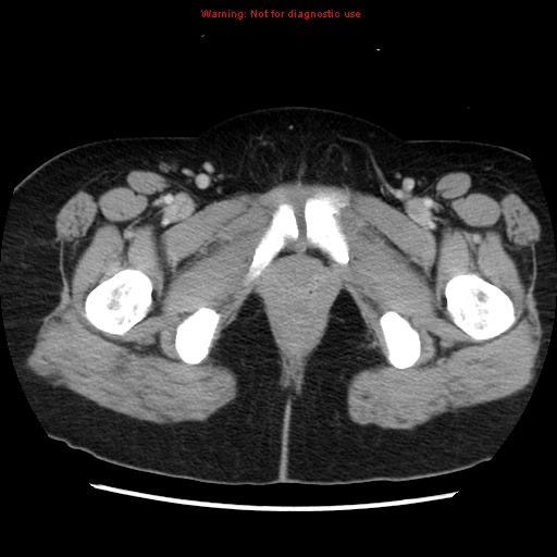 Appendiceal mucinous cystadenoma (Radiopaedia 8263-9111 Axial liver window 84).jpg