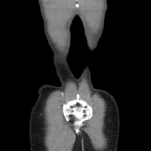 File:Appendicitis complicated by post-operative collection (Radiopaedia 35595-37113 B 51).jpg