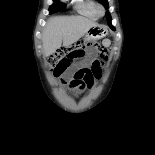 Appendicitis complicated by post-operative collection (Radiopaedia 35595-37114 B 12).jpg