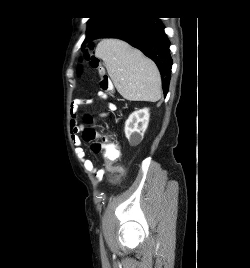 Appendicitis with localized perforation and abscess formation (Radiopaedia 49035-54130 C 13).jpg
