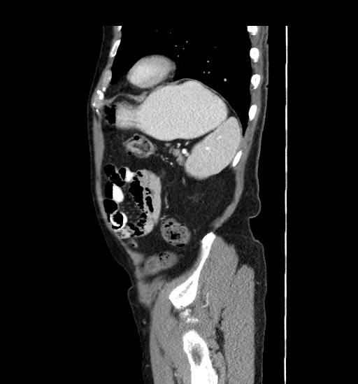 Appendicitis with localized perforation and abscess formation (Radiopaedia 49035-54130 C 53).jpg
