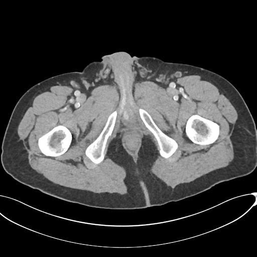 Appendicitis with thickening of the terminal ileum (Radiopaedia 42432-45550 A 103).png