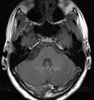 File:Arachnoid cyst - cerebellopontine angle (Radiopaedia 59689-67083 Axial T1 12).png