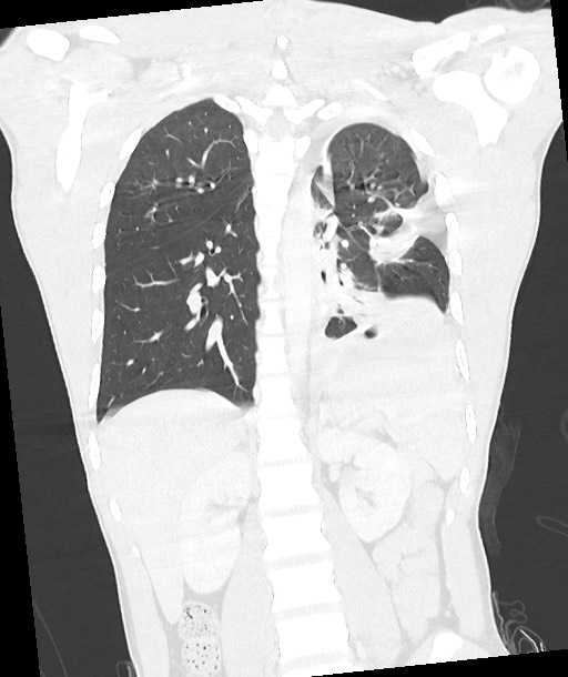 Arrow injury to the chest (Radiopaedia 85367-100975 Coronal lung window 90).jpg