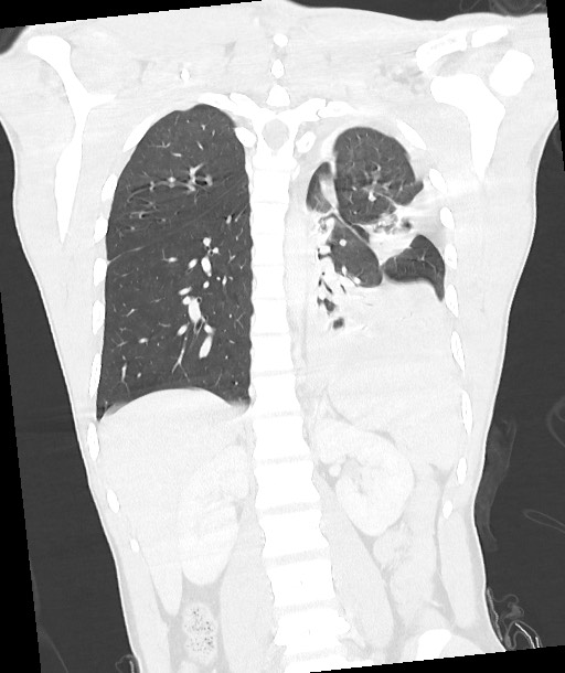 Arrow injury to the chest (Radiopaedia 85367-100975 Coronal lung window 92).jpg