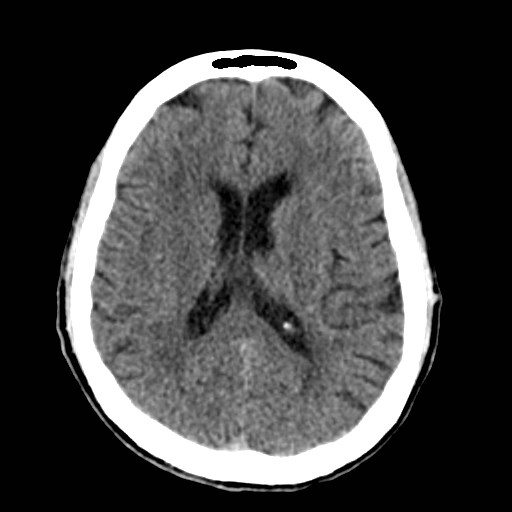 File:Artery of Percheron infarct (Radiopaedia 48088-52893 Axial non-contrast 26).jpg