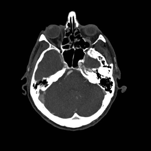 File:Artery of Percheron infarct (Radiopaedia 48088-52894 A 118).jpg