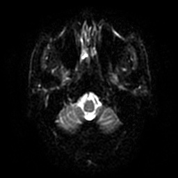 File:Artery of Percheron infarction (Radiopaedia 27975-28230 Axial DWI 29).jpg