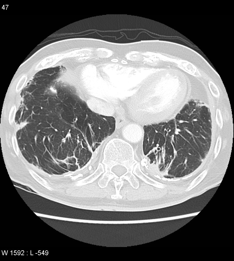 Asbestos related lung and pleural disease (Radiopaedia 14377-14301 A 44).jpg