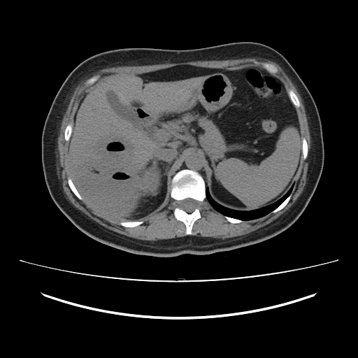 Ascending retrocecal appendicitis with liver abscesses (Radiopaedia 60066-67615 Axial non-contrast 24).jpg