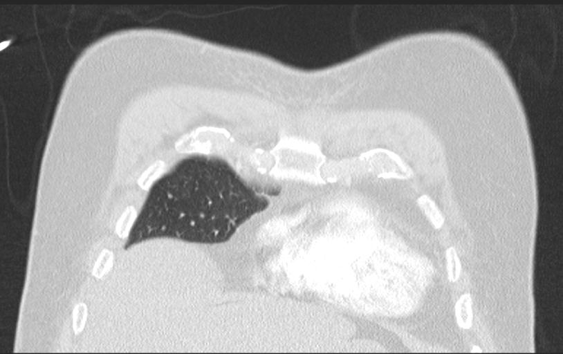 Aspirated tooth (Radiopaedia 28584-28844 Axial lung window 30).jpg