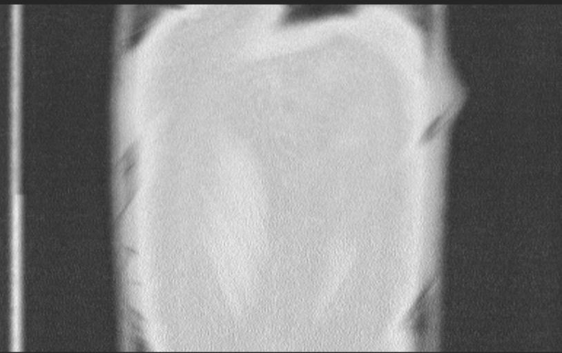 Aspirated tooth (Radiopaedia 28584-28844 Axial lung window 97).jpg