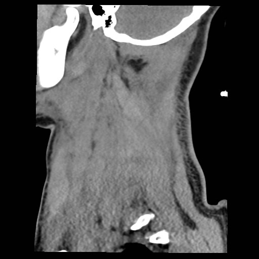 File:Atlanto-occipital dislocation (Radiopaedia 44648-48412 A 2).jpg