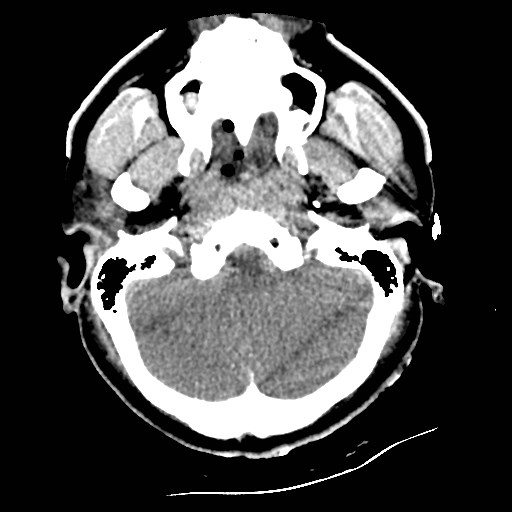 Atlanto-occipital dislocation (Radiopaedia 44648-48412 Axial non-contrast 11).jpg