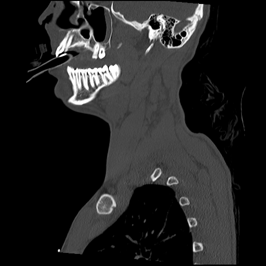File:Atlanto-occipital dissociation (Traynelis type 1), C2 teardrop fracture, C6-7 facet joint dislocation (Radiopaedia 87655-104061 Sagittal bone window 14).jpg