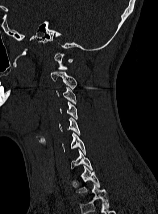 Atlantoaxial subluxation (Radiopaedia 44681-48450 Sagittal bone window 135).jpg