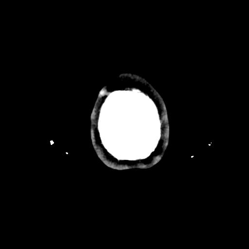 Atretic cephalocele (Radiopaedia 89782-106881 Axial non-contrast 186).jpg