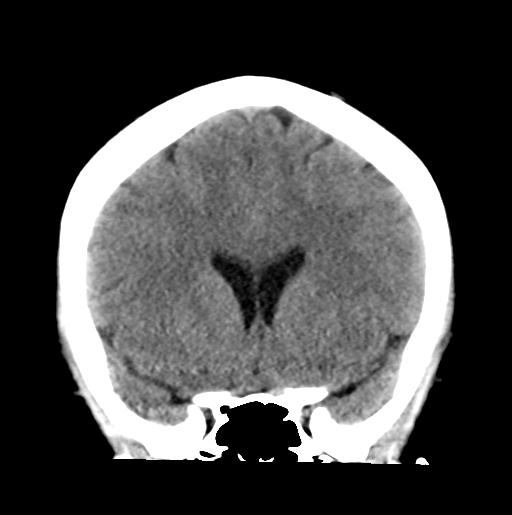 File:Atretic encephalocoele with inferior vermis hypoplasia (Radiopaedia 30443-31107 Coronal non-contrast 15).jpg