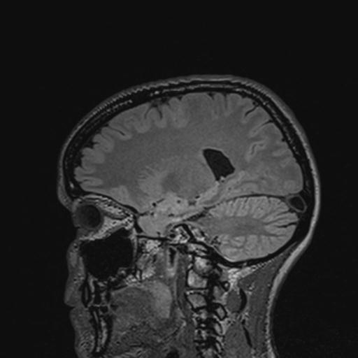 Atretic encephalocoele with inferior vermis hypoplasia (Radiopaedia 30443-31108 Sagittal FLAIR 100).jpg