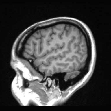 Atretic encephalocoele with inferior vermis hypoplasia (Radiopaedia 30443-31108 Sagittal T1 18).jpg