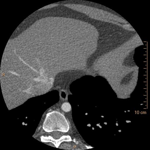 File:Atrial septal defect (upper sinus venosus type) with partial anomalous pulmonary venous return into superior vena cava (Radiopaedia 73228-83961 A 256).jpg