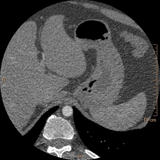 Atrial septal defect (upper sinus venosus type) with partial anomalous pulmonary venous return into superior vena cava (Radiopaedia 73228-83961 A 307).jpg