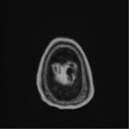 Atypical meningioma (WHO Grade II) (Radiopaedia 54742-60979 Axial T1 C+ 65).png