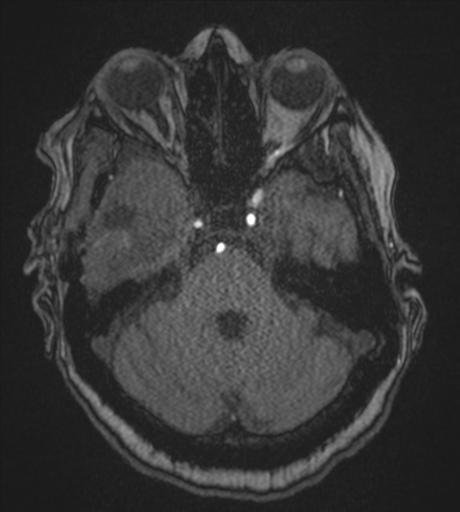 Atypical meningioma (WHO Grade II) (Radiopaedia 54742-60981 Axial MRA 28).png