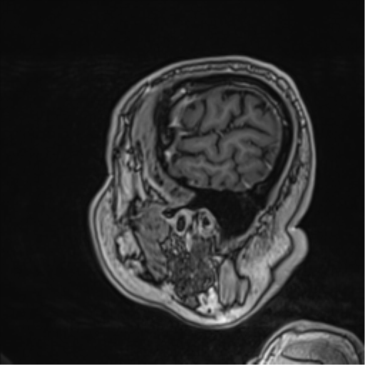 Atypical meningioma (WHO grade II) with brain invasion (Radiopaedia 57767-64729 Sagittal T1 C+ 15).png