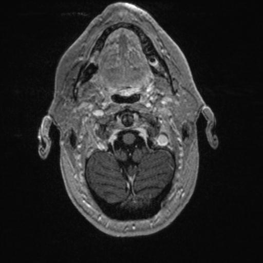 Atypical meningioma (grade II) - en plaque (Radiopaedia 29633-30147 Axial T1 C+ 23).jpg