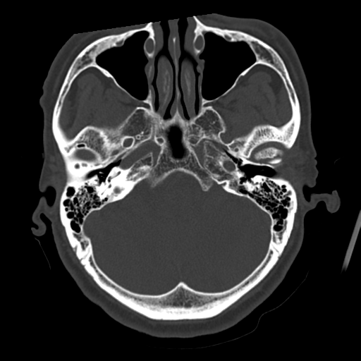 Atypical meningioma with skull invasion (Radiopaedia 34357-35649 Axial bone window 19).png