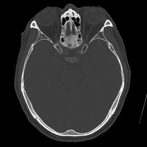 Atypical meningioma with skull invasion (Radiopaedia 34357-35649 Axial bone window 32).png