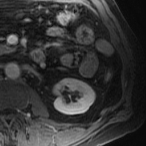 File:Atypical renal cyst on MRI (Radiopaedia 17349-17046 D 21).jpg