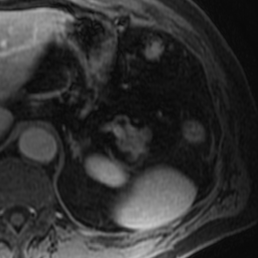 File:Atypical renal cyst on MRI (Radiopaedia 17349-17046 D 3).jpg